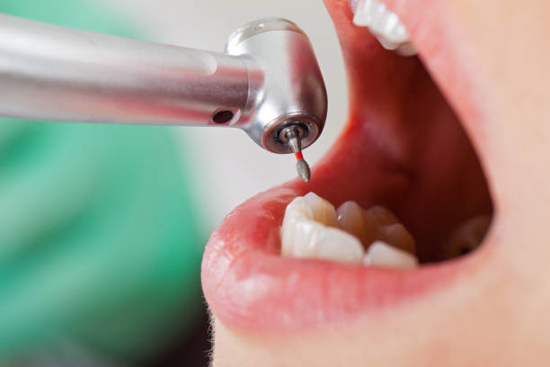 Best Emergency Treatment for Toothache in Milford City, CT
